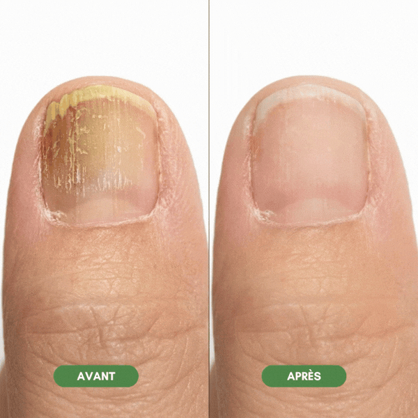 onyvia.® - Stylo Sérum Mycose des ongles